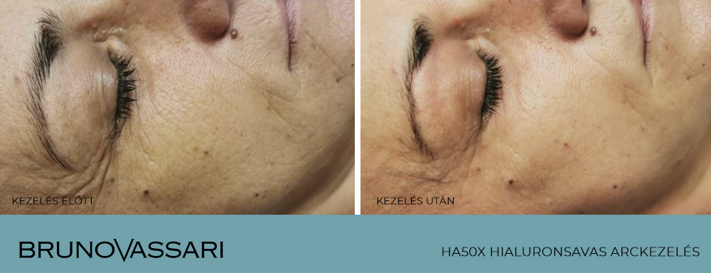 HA50X arckezelés eredménye - Bruno Vassari Hungary